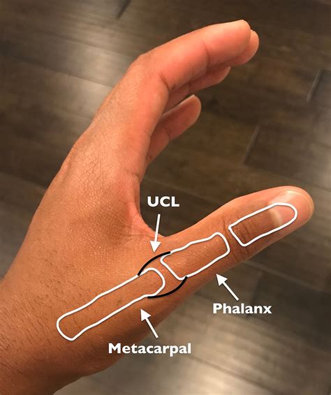 pain after UCL thumb surgery